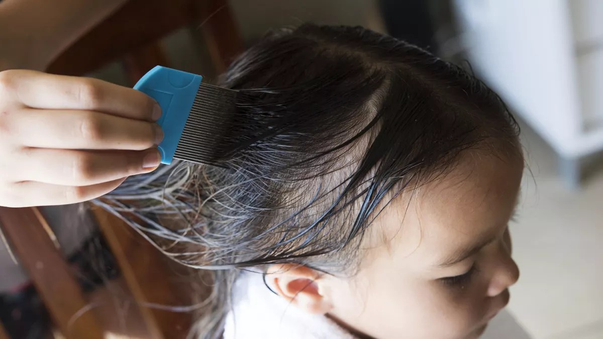 Kutu rambut obat alami telurnya terbukti ampuh telur disimpan dari